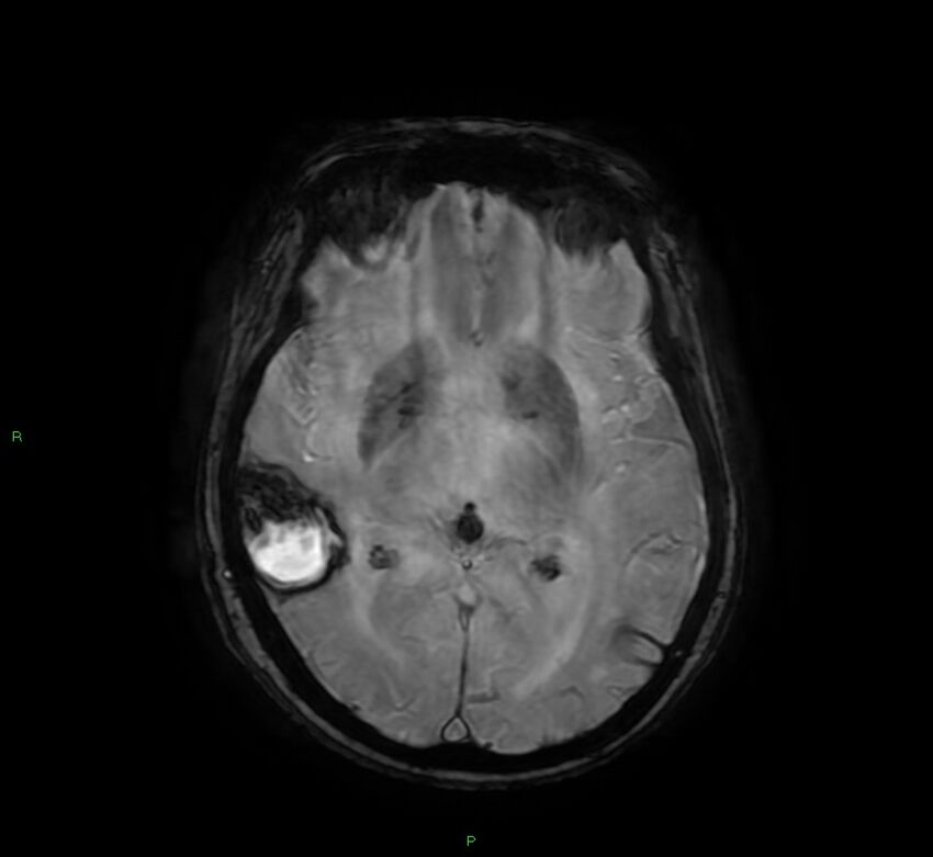 Cerebral amyloid angiopathy-associated lobar intracerebral hemorrhage (Radiopaedia 58378-65517 Axial SWI 36).jpg