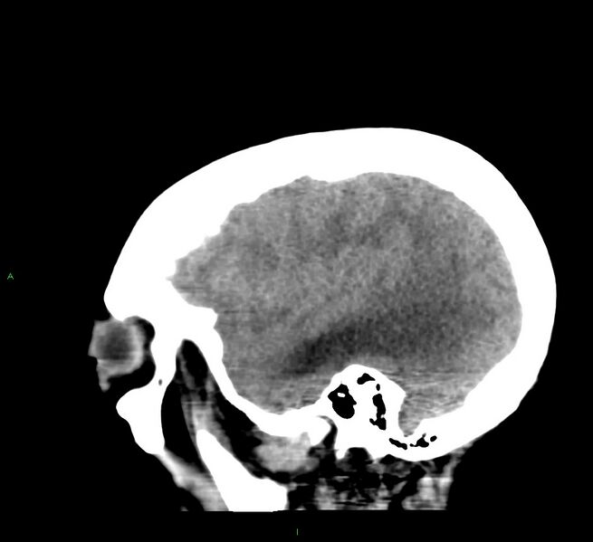 File:Cerebral amyloid angiopathy-associated lobar intracerebral hemorrhage (Radiopaedia 58379-65519 C 42).jpg