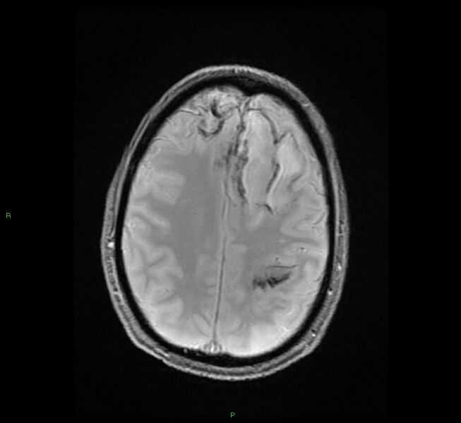 File:Cerebral amyloid angiopathy-associated lobar intracerebral hemorrhage (Radiopaedia 58529-65684 Axial Gradient Echo 19).jpg
