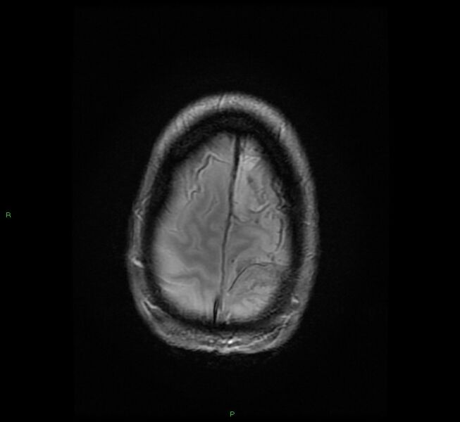 File:Cerebral amyloid angiopathy-associated lobar intracerebral hemorrhage (Radiopaedia 58529-65684 Axial Gradient Echo 23).jpg