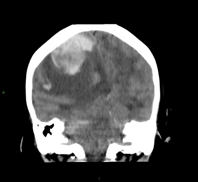 File:Cerebral amyloid angiopathy-associated lobar intracerebral hemorrhage (Radiopaedia 58751-65972 Coronal non-contrast 27).jpg