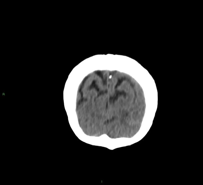 File:Cerebral amyloid angiopathy-associated lobar intracerebral hemorrhage (Radiopaedia 58757-65978 Coronal non-contrast 11).jpg