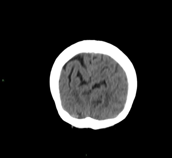 File:Cerebral amyloid angiopathy-associated lobar intracerebral hemorrhage (Radiopaedia 58757-65978 Coronal non-contrast 13).jpg
