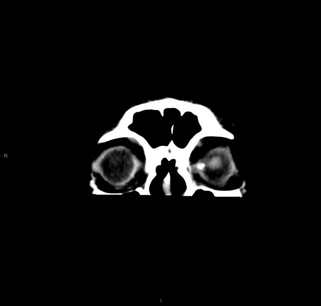 File:Cerebral amyloid angiopathy-associated lobar intracerebral hemorrhage (Radiopaedia 59356-66716 Coronal non-contrast 61).jpg