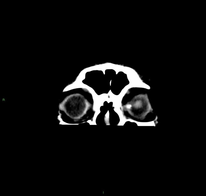Cerebral amyloid angiopathy-associated lobar intracerebral hemorrhage (Radiopaedia 59356-66716 Coronal non-contrast 61).jpg