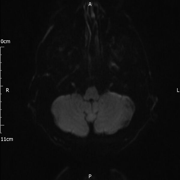 File:Cerebral amyloid angiopathy related inflammation (Radiopaedia 72772-83415 Axial DWI 28).jpg