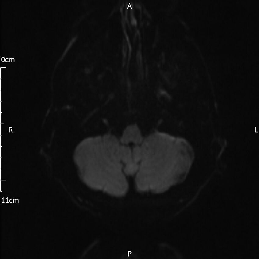 Cerebral amyloid angiopathy related inflammation (Radiopaedia 72772-83415 Axial DWI 28).jpg
