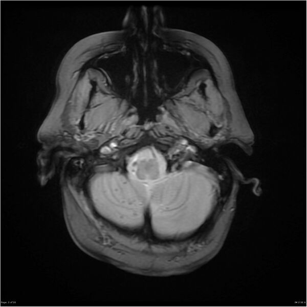 File:Cerebral amyloid microangiopathy (Radiopaedia 15822).jpg