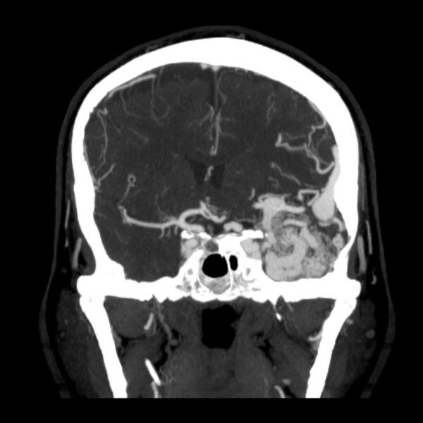 File:Cerebral arteriovenous malformation (Radiopaedia 43729-47189 C 19).jpg