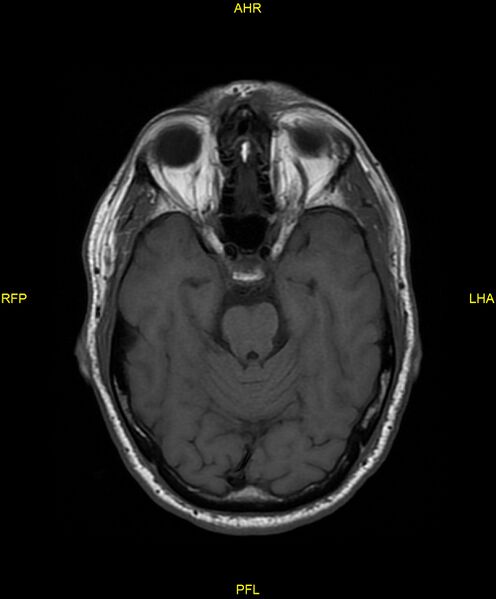 File:Cerebral autosomal dominant arteriopathy with subcortical infarcts and leukoencephalopathy (CADASIL) (Radiopaedia 86108-102054 Axial T1 11).jpg