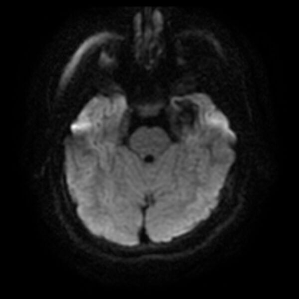 File:Cerebral cavernous malformation (Radiopaedia 44301-47942 Axial DWI 7).jpg