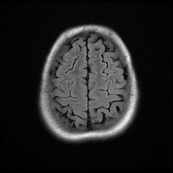 File:Cerebral cavernous malformation (Radiopaedia 44301-47942 Axial FLAIR 18).jpg
