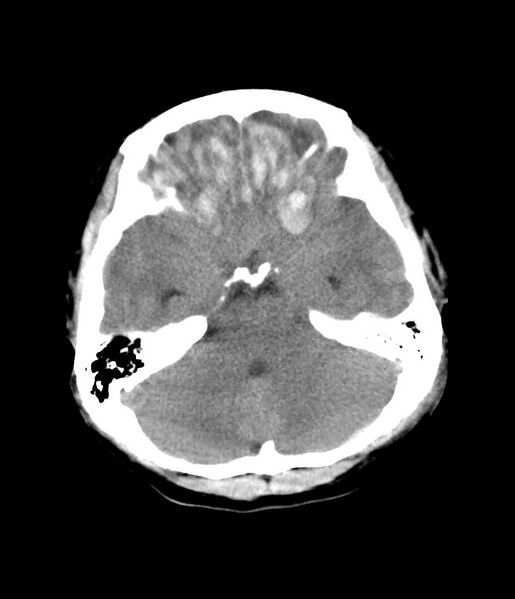File:Cerebral contusions - bifrontal (Radiopaedia 7149).jpg