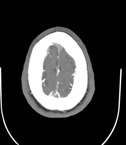 File:Cerebral dural venous sinus thrombosis (Radiopaedia 86514-102576 A 85).jpg