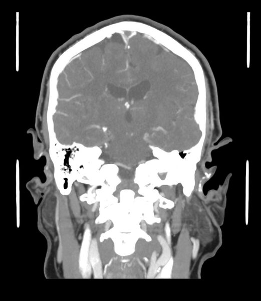 File:Cerebral dural venous sinus thrombosis (Radiopaedia 86514-102576 B 39).jpg