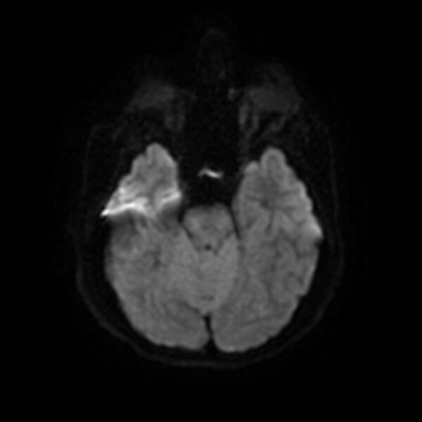 File:Cerebral fat embolism (Radiopaedia 37510-39363 Axial DWI 10).jpg