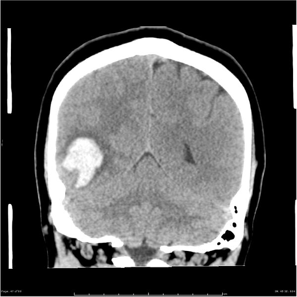 File:Cerebral hemorrhage secondary to arteriovenous malformation (Radiopaedia 33497-34561 Coronal non-contrast 38).jpg