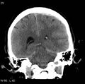 Cerebral hemorrhagic contusion with subdural and subarachnoid hemorrhage (Radiopaedia 10680-11146 Coronal non-contrast 12).jpg