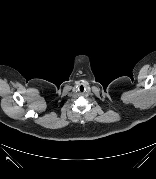File:Cervical aortic arch with coarctation and aneurysms (Radiopaedia 44035-47552 Axial non-contrast 2).jpg