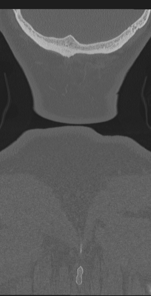 File:Cervical canal stenosis - OPLL and osteophytes (Radiopaedia 47329-51910 Coronal bone window 76).png