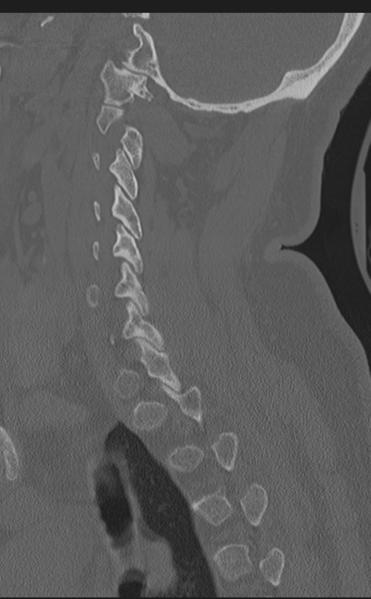 File:Cervical canal stenosis due to ossification of the posterior longitudinal ligament (Radiopaedia 47260-51823 Sagittal bone window 52).png