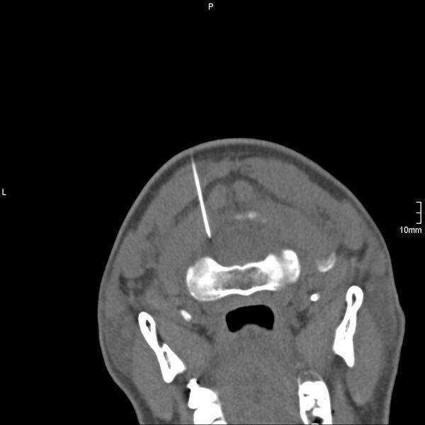 File:Cervical dural CSF leak on MRI and CT treated by blood patch (Radiopaedia 49748-54996 Axial non-contrast 2).jpg