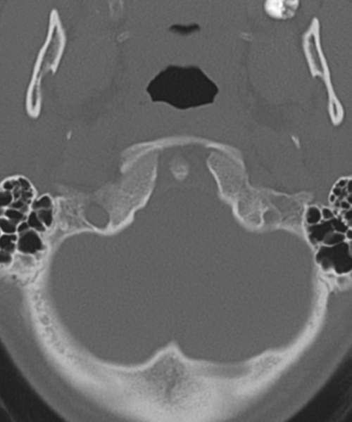 File:Cervical intercalary bone (Radiopaedia 35211-36748 Axial bone window 10).png