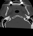 Cervical spine ACDF loosening (Radiopaedia 48998-54070 Axial bone window 6).png