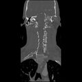 Cervical spine fractures with vertebral artery dissection (Radiopaedia 32135-33078 Coronal bone window 16).jpg