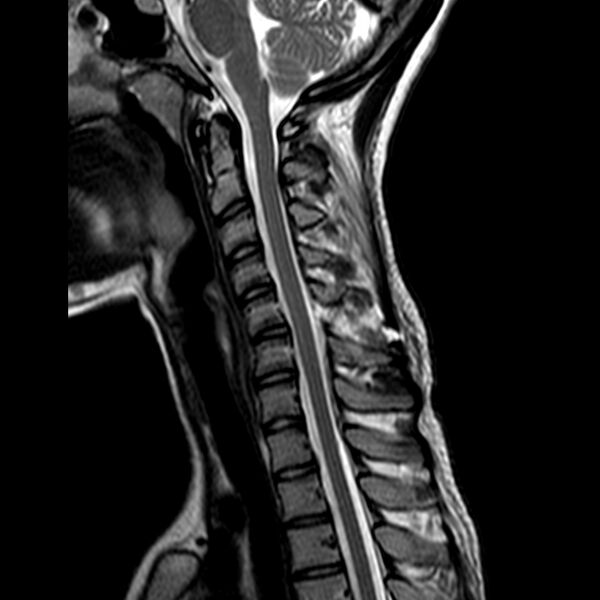 File:Cervical spine posterior ligamentous complex rupture (Radiopaedia 63486-72103 Sagittal T2 7).jpg