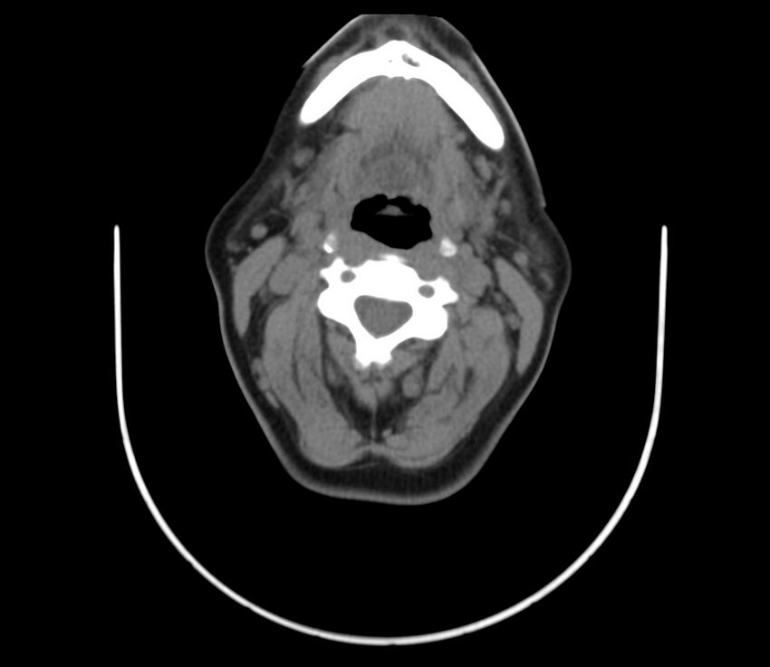 Cervical venous malformation (Radiopaedia 22653-22672 Axial non-contrast 28).jpg