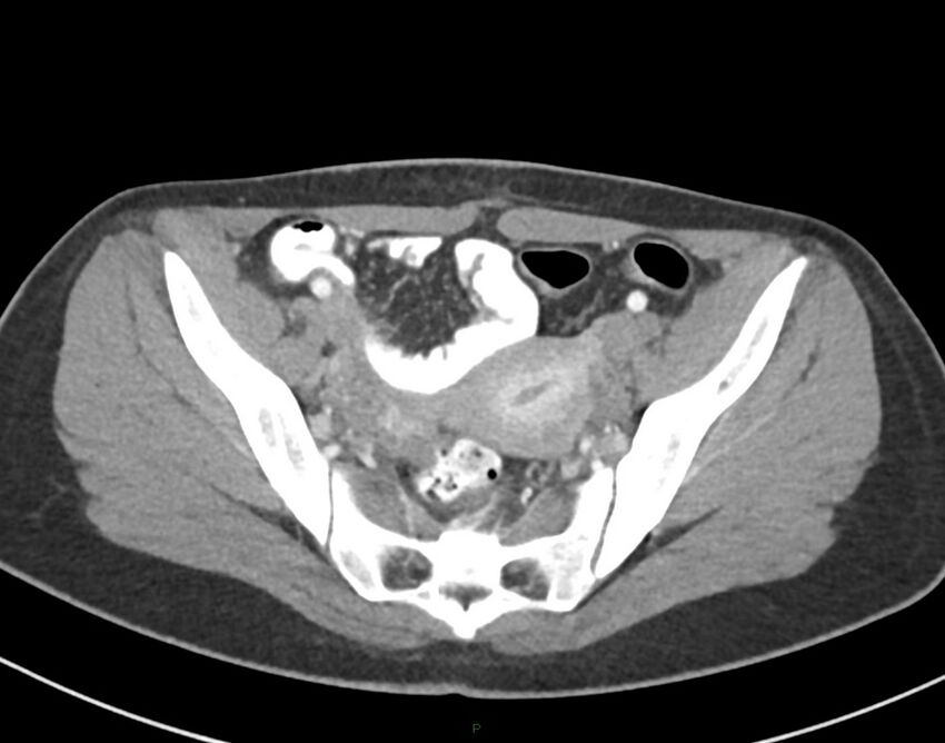Cesarean scar endometriosis (Radiopaedia 82925-97262 A 70).jpg