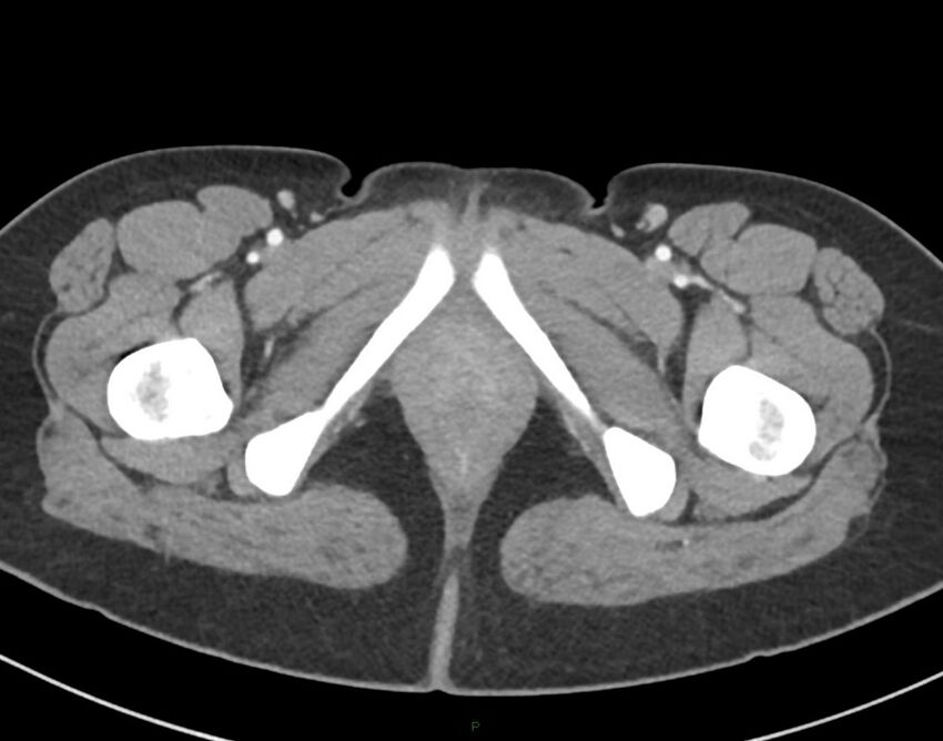 Cesarean scar endometriosis (Radiopaedia 82925-97262 A 92).jpg