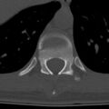 Chance fracture (Radiopaedia 36521-38081 Axial bone window 14).jpg