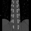 Chance fracture (Radiopaedia 36521-38081 Coronal bone window 34).jpg
