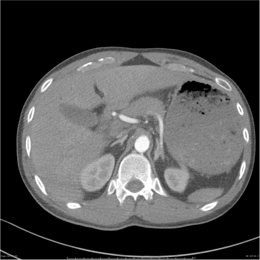 Chest and abdomen multi-trauma (Radiopaedia 26294-26425 A 105).jpg