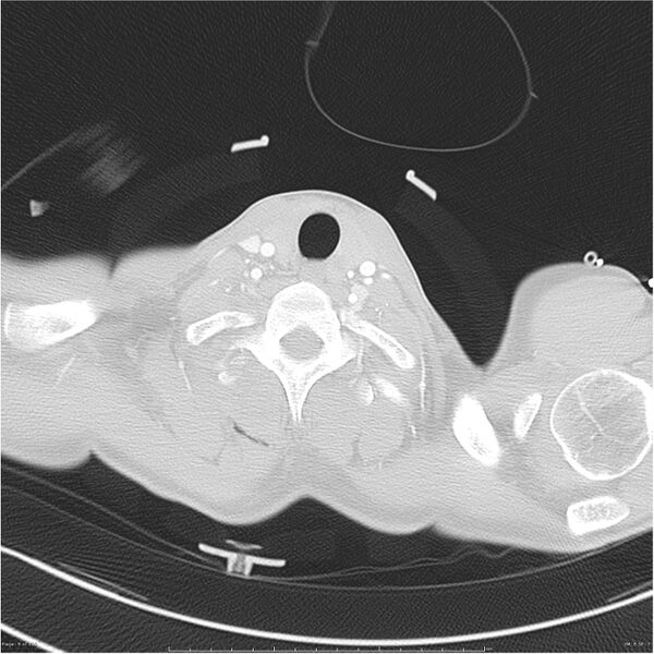 File:Chest and abdomen multi-trauma (Radiopaedia 26294-26425 lung window 8).jpg