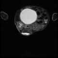 Chiari II malformation with spinal meningomyelocele (Radiopaedia 23550-23652 Axial T2 12).jpg