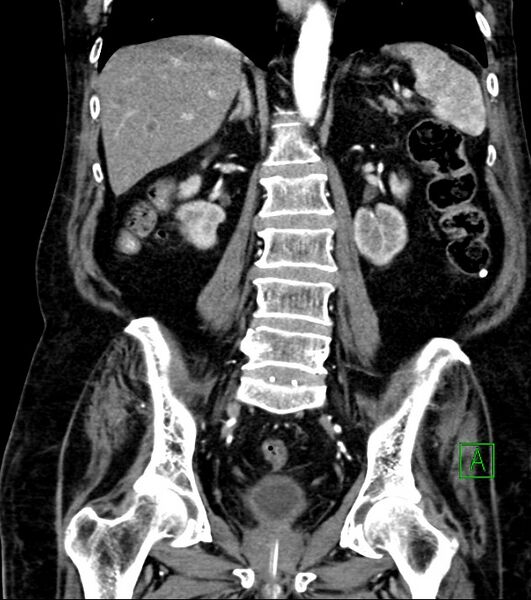 File:Cholangiocarcinoma with cerebral metastases (Radiopaedia 83519-98629 E 56).jpg