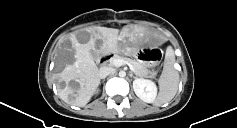File:Choriocarcinoma liver metastases (Radiopaedia 74768-85766 A 78).jpg