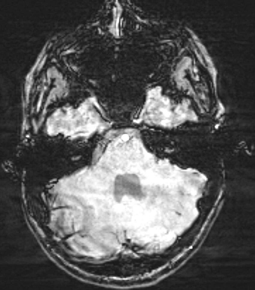 Choroid plexus carcinoma (Radiopaedia 91013-108553 Axial SWI 25).jpg