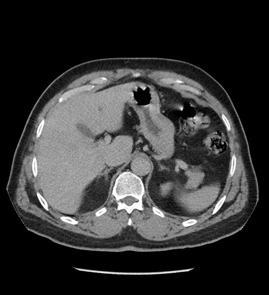 File:Chromophobe renal cell carcinoma (Radiopaedia 86879-103083 D 30).jpg