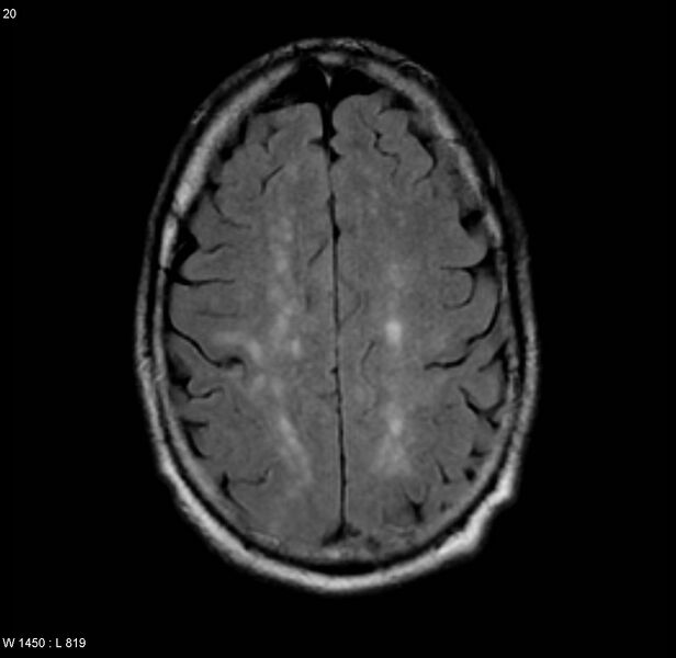 File:Chronic hypertensive encephalopathy (Radiopaedia 4564-6686 Axial FLAIR 13).jpg