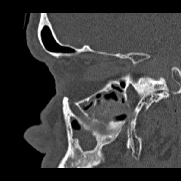 File:Chronic maxillary sinusitis (Radiopaedia 27879-28116 Sagittal bone window 16).jpg