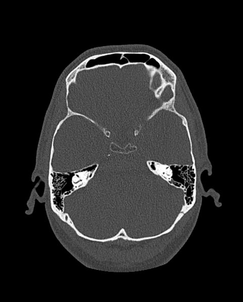 File:Chronic maxillary sinusitis caused by a foreign body (Radiopaedia 58521-65676 Axial bone window 267).jpg
