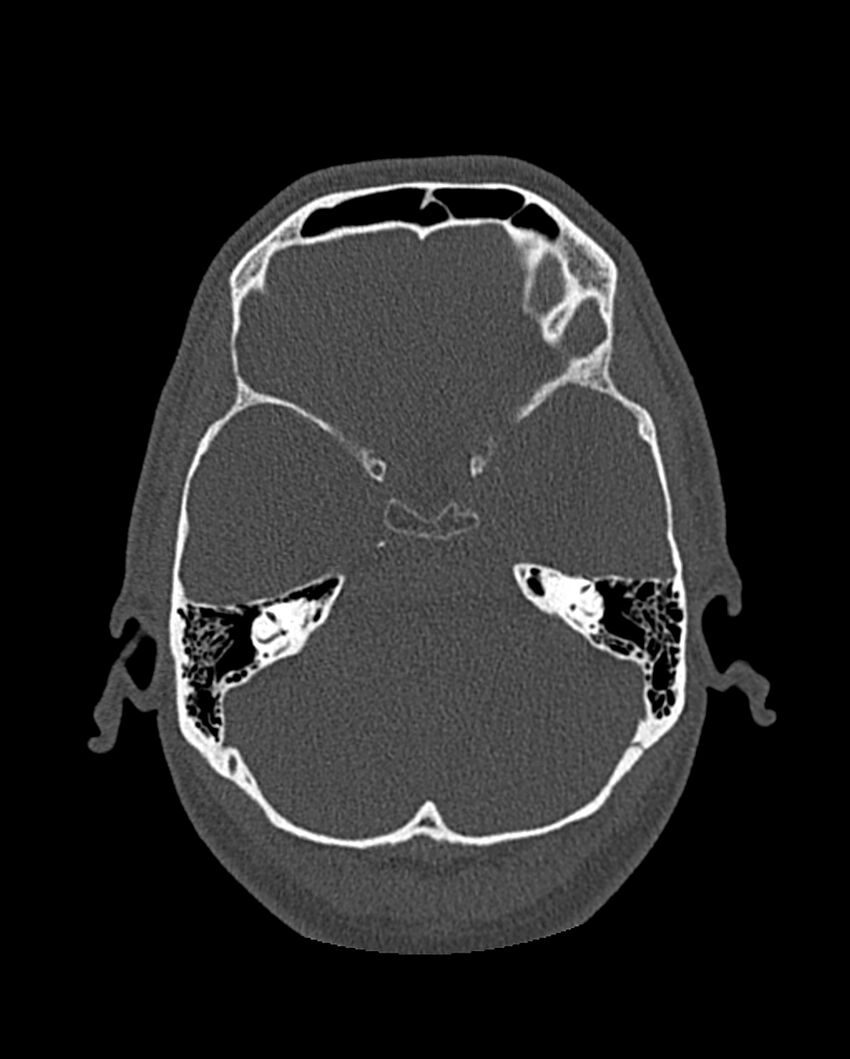 Chronic maxillary sinusitis caused by a foreign body (Radiopaedia 58521-65676 Axial bone window 267).jpg