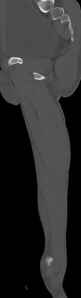 File:Chronic osteomyelitis (with sequestrum) (Radiopaedia 74813-85822 C 48).jpg