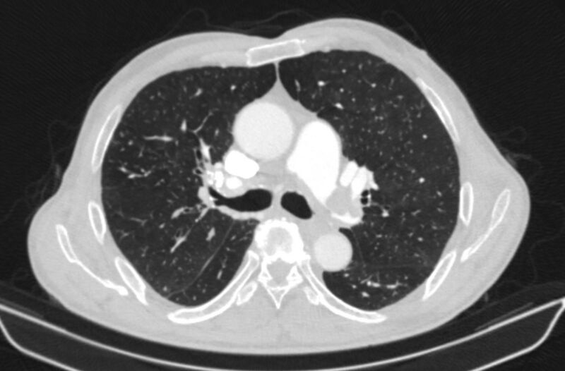 File:Chronic pulmonary embolism (Radiopaedia 91241-108843 Axial lung window 37).jpg