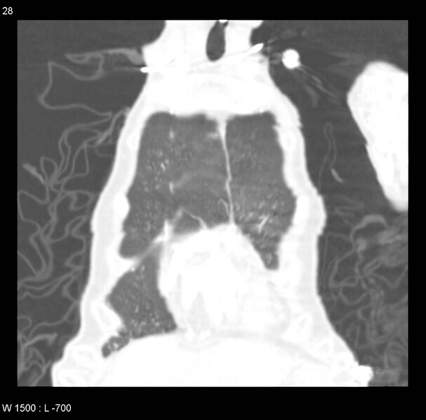 File:Clagett thoracotomy (Radiopaedia 8568-9403 Coronal lung window 28).jpg