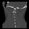Clay-shoveler fracture (Radiopaedia 22568-22590 Coronal bone window 31).jpg